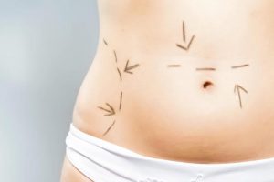 Tummy Tuck