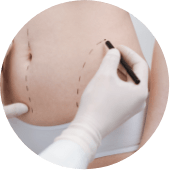 Autologous Fat Grafting